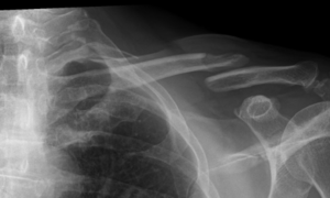 Radiografie van een gebroken linker sleutelbeen